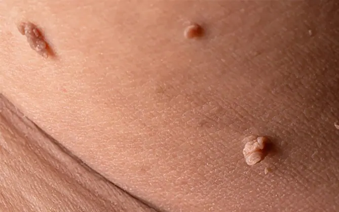 Genital Siğil Kesin 