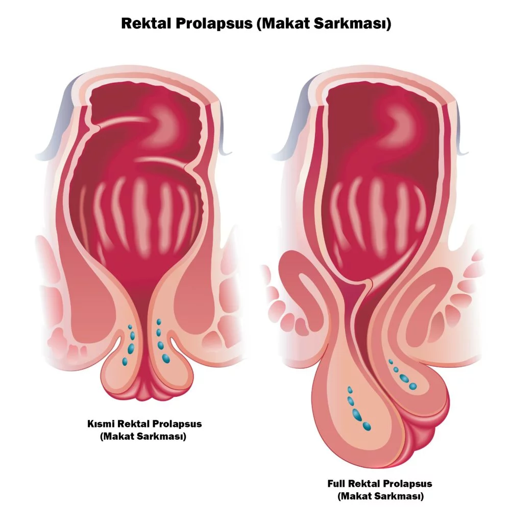 Rektal-Prolapsus-Makat-Sarkmasi