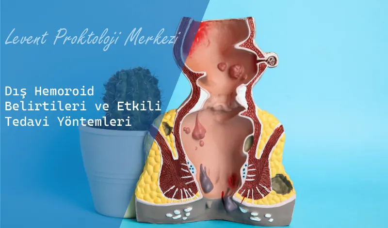 Dış Hemoroid Belirtileri ve Etkili Tedavi Yöntemleri