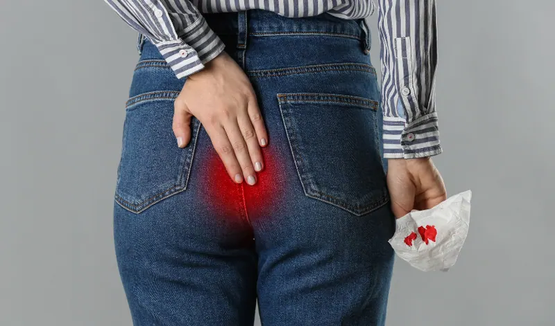 anal fissür