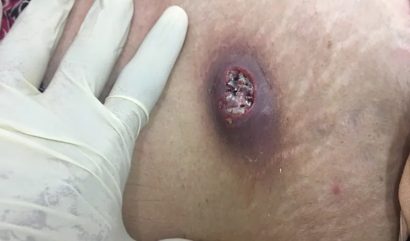 Perianal Apse