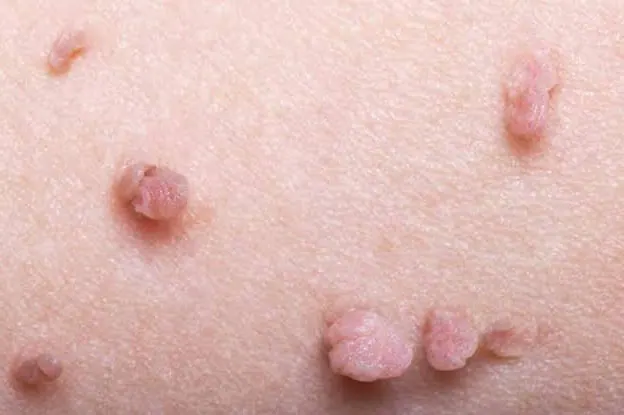 Anal kondilom, İnsan Papilloma Virüsü (HPV)