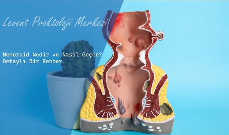 Hemoroid Nedir ve Nasıl Geçer? Detaylı Bir Rehber