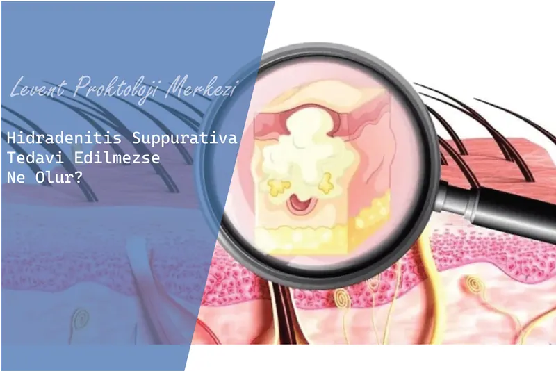 Hidradenitis Suppurativa Tedavi Edilmezse Ne Olur?
