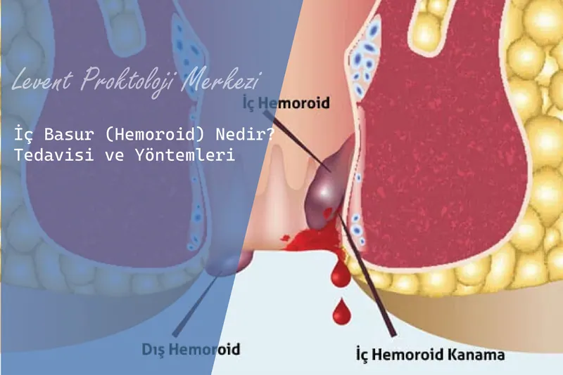 İç Basur (Hemoroid) Nedir? Tedavisi ve Yöntemleri