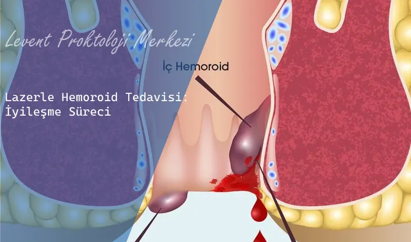 Lazerle Hemoroid Tedavisi: İyileşme Süreci