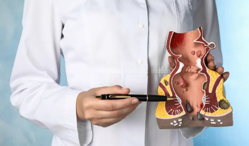 Hemoroid Nedir ve Nasıl Geçer?