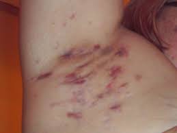 Hidradenitis suppurativa Hastalığı 