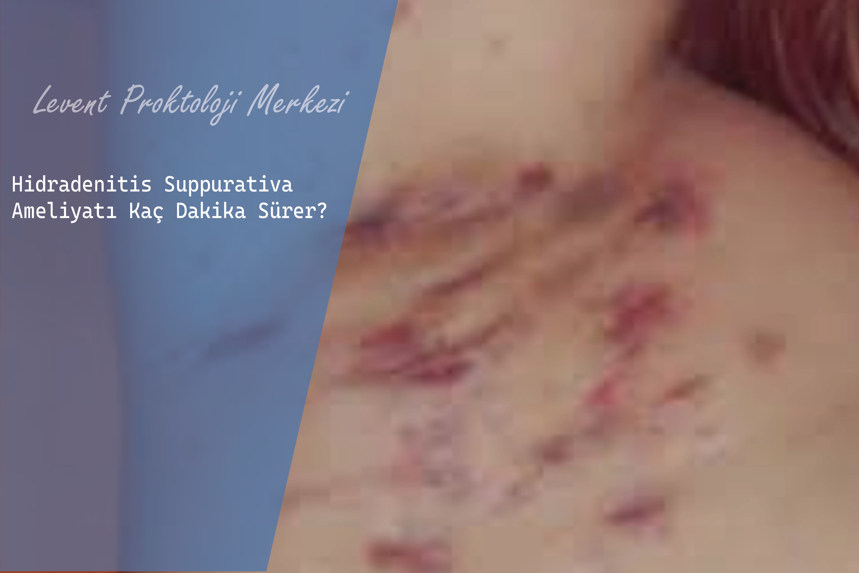 Hidradenitis Suppurativa Ameliyatı Kaç Dakika Sürer