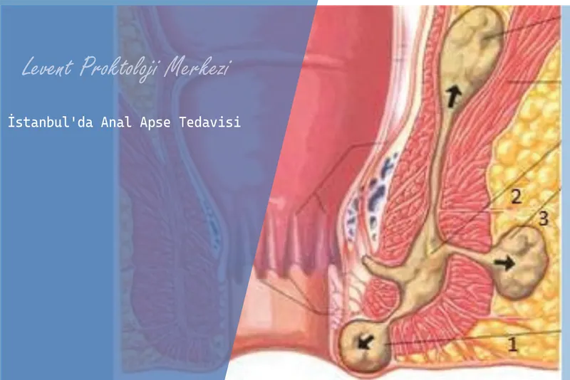 İstanbul'da Anal Apse Tedavisi