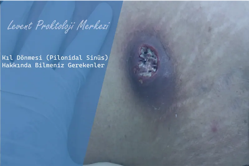 Kıl Dönmesi (Pilonidal Sinüs) Hakkında Bilmeniz Gerekenler