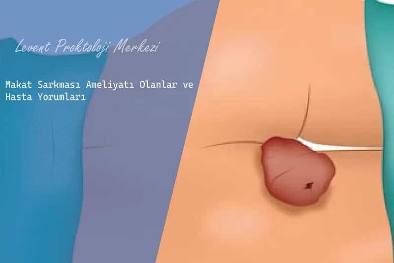 Makat Sarkması Ameliyatı Olanlar ve Hasta Yorumları