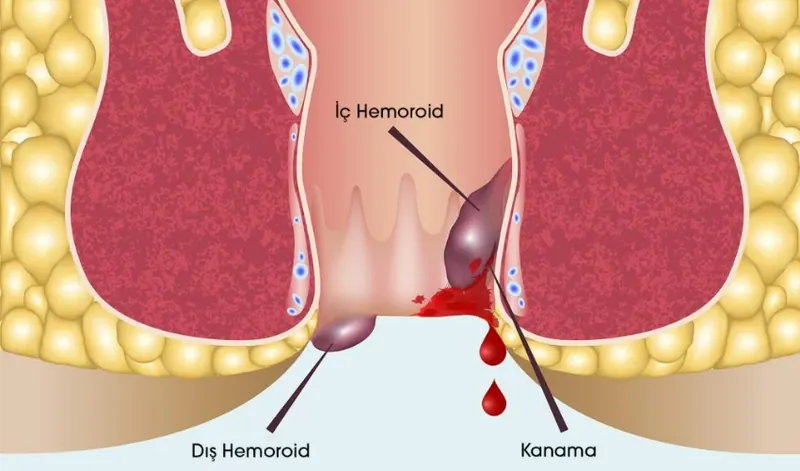 iç hemoroid (basur)