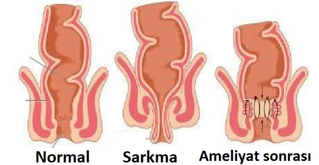 Makat sarkması (rektal prolapsus)