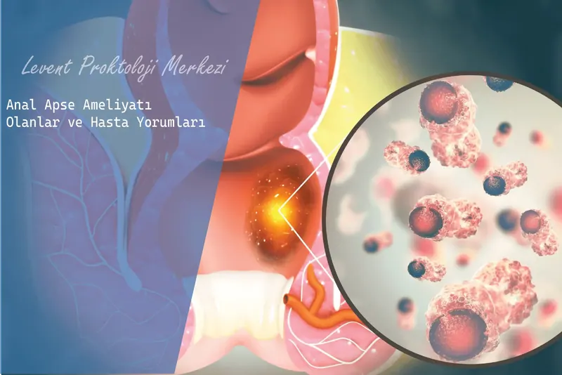 Anal Apse Ameliyatı Olanlar ve Hasta Yorumları