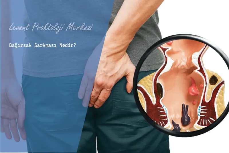 Bağırsak Sarkması Nedir?