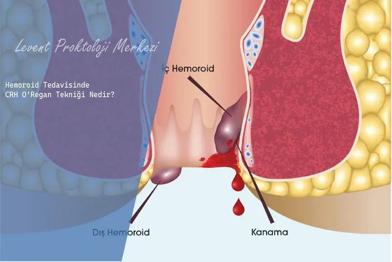 Hemoroid Tedavisinde CRH O'Regan Tekniği Nedir?