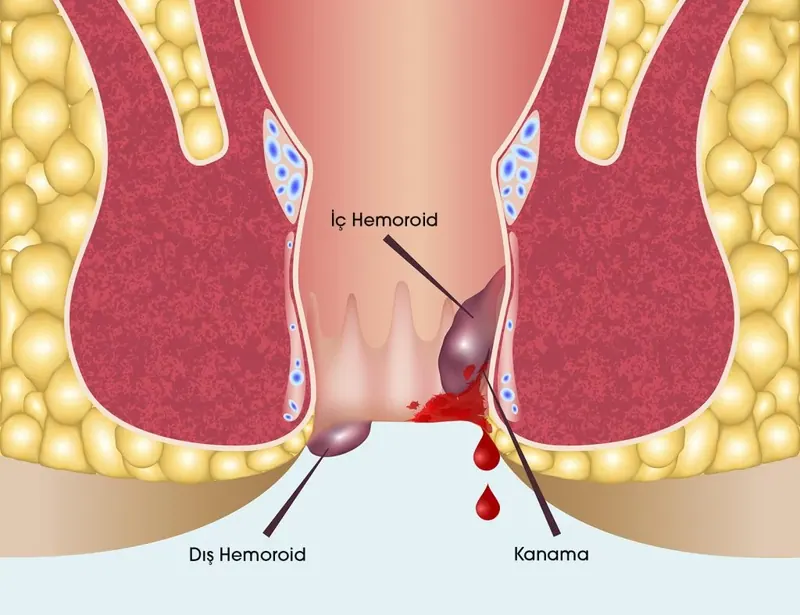 Hemoroid