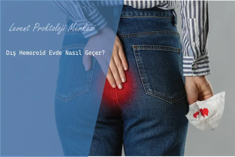 Dış Hemoroid Evde Nasıl Geçer?