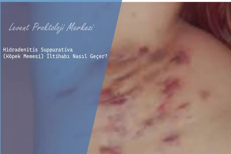 Hidradenitis Suppurativa(Köpek Memesi) İltihabı Nasıl Geçer