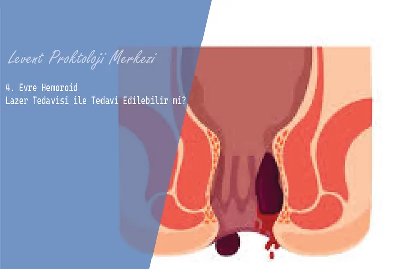 4. Evre Hemoroid Lazer Tedavisi ile Tedavi Edilebilir mi?
