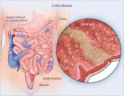 Crohn hastalığı