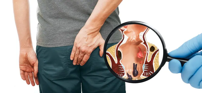 4. evre hemoroid nedir?