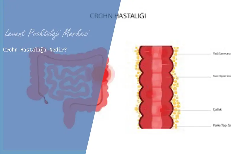 Crohn hastalığı belirtileri ve tedavisi
